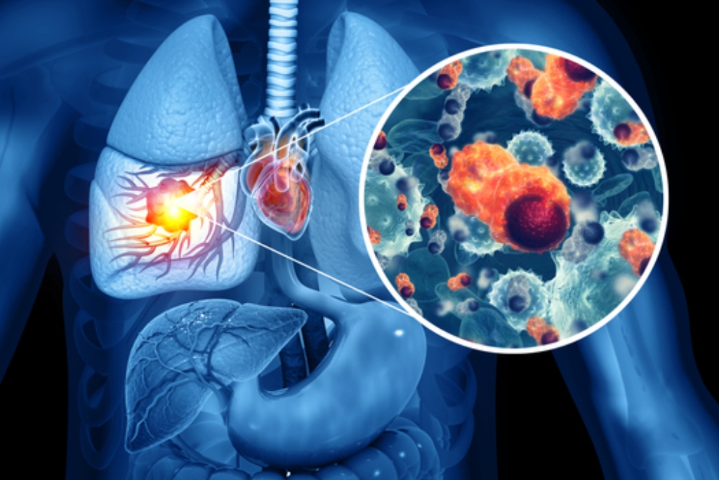 Interstitial lung disease treatment by pulmonologist in Vadodara