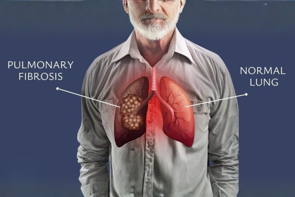 Pulmonary fibrosis treatment by pulmonologist in Vadodara